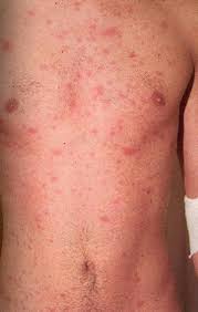 Image result for skin rash acute hiv infection