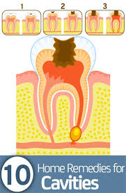 22 Amazingly Effective Home Remedies For Cavities Home Remedies For Cavities Natural Home Remedies Home Health