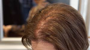 Combing your thin hair forward is one of the most effective methods if you have a receding hairline. Hairstyles For Thin Hair To Try Now