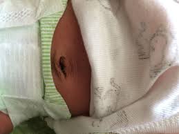 If even after your careful diapering and care the umbilical. Umbilical Cord Fell Off But Still No Bath The Bump