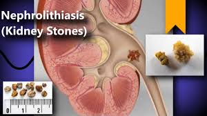 Image result for Nephrolithiasis