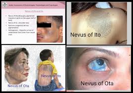 Nevus Of Ota And Ito