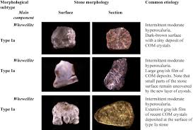 Comprehensive Morpho Constitutional Analysis Of Urinary Stones Improves Etiological Diagnosis And Therapeutic Strategy Of Nephrolithiasis Sciencedirect