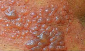 Herpes infections are very common. Genital Herpes Treatment At Home Hsv 2 Online Treatment Herp Alert