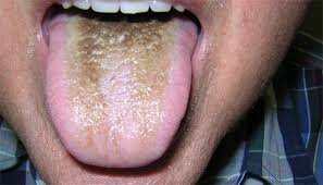 Image result for black hairy tongue symptoms