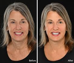 Retouching Before & After