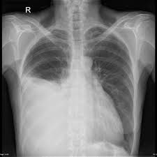 Pleural Effusion Unilateral Malignant Large Unilateral Right Sided Effusion The Heart Is Enlarged Especi Pleural Effusion Radiology Pediatric Radiology