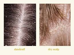 Scaly, crusty scalp in infants with cradle cap. Dandruff Vs Dry Scalp Causes Symptoms And Best Treatments Dry Scalp Dry Scalp Vs Dandruff Dry Scalp Patch