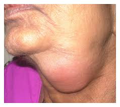 Image result for Sialoadenitis