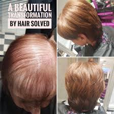 Hair Solved S Solution To All Types Of Female Hair Loss And Thinning Hair Hair Loss Women Hair Replacement Systems Hair Loss Causes