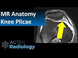 Normal knee mri · coronal: Mri Anatomy Of Knee Plicae Youtube