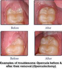 Operculectomy Exodontia