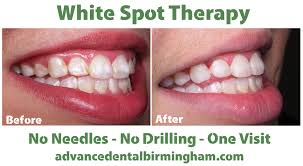 This fragile area results from a process called hypocalcification, which some patients choose to wait until their next routine exam and teeth cleaning, whereas others make an extra appointment to determine how to strengthen. What Are White Spots On Teeth And What Can You Do About Them Advance Dental Pc Dentist Birmingham Al