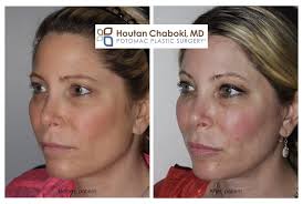 Juvederm and similar hyaluronic fillers are hydrophilic and take up water from your skin tissue. Reducing Swelling After Injectable Fillers In Dc Dr Houtan Chaboki