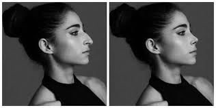A rhinoplasty would be required to change the shape of the nose, her nose job did change the outside of her nose but she lied about it for whatever reason. Sometimes All You Need Is A Nose Job Vindicta