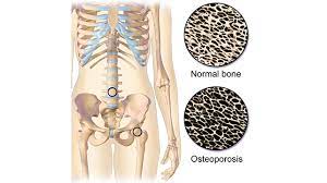 1.exercise just 30 minutes of exercise each day can help strengthen bones and prevent osteoporosis. Osteoporosis Everything You Need To Know