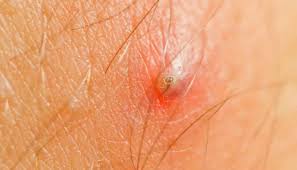 It does not give you a lot of confidence going out in public. Laser For Ingrown Hair Scars By Clear Skincare Clinics
