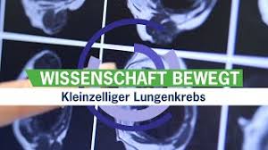 Kleinzelliger Lungenkrebs Zwei Neue Ansatzpunkte Fur Therapien Wissenschaftsnachrichtenvideo Youtube