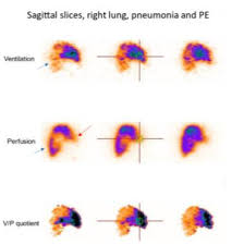 Image result for Ventilation Perfusion Scan