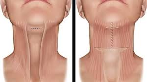Instant face, neck and eye lift tapes and bands (dark and light hair). 4 Wet Hairstyles To Get You Out The Door Fast How To Style Wet Hair Saggy Jowls Wet Hair