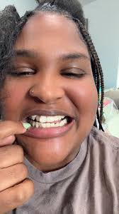 Help‼️ extra tooth at top and bottom Should I just skip the braces part And  get veneers if so what would the steps be? Looking for doctors in Miami Tia  💕