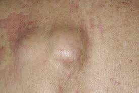 When you have a cold or even a minor infection, your lymph nodes may swell because they're being. Lipoma Nhs