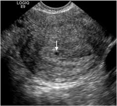 Image result for First Trimester Ultrasound