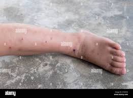 Dermatitis Atopica Picor Del Pie Del Bebe Cerrar Herida Infectada Herida Abierta En La Pierna Izquierda Fotografia De Stock Alamy