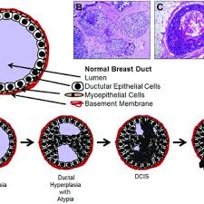 Disability benefits for ductal carcinoma in situ solely depends on the severity and classification of the carcinoma. Pdf Breast Ductal Carcinoma In Situ Precursor To Invasive Breast Cancer