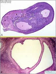The graafian follicle is the stage after the first meiotic division has completed but before ovulation. Female Genitalia Ovary Ovarian Follicle Graafian Follicle Tertiary Follicle Cumulus Oophorus Granulosa Cells Poja Collection Microscopic Anatomy