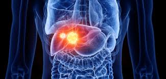 癌症也可能從其他部位轉移到肝臟，稱為 肝轉移瘤 （英語：liver metastasis） ，其比例比肝臟原生性的腫瘤要高 。. è‚ç™Œ äº†è§£æˆå›  ç—…å¾µ æœŸæ•¸åˆ†åˆ¥ å­˜æ´»çŽ‡ æª¢æŸ¥ æ²»ç™‚æ–¹æ³• Bowtie