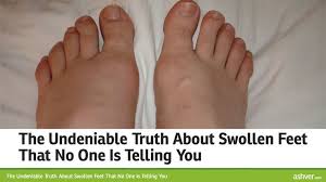 The Undeniable Truth About Swollen Feet That No One Is Telling You Swollen Feet Remedy Foot Remedies Swollen Feet