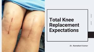 How far should i be walking after knee replacement. How Much Walking After Knee Replacement Archives Enliven Articles