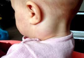 Uvelicheny Limfouzly Na Shee U Rebenka Prichiny Simptomy I Lechenie Gorodskaya Klinicheskaya Bolnica 1