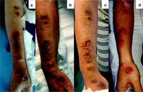 Check spelling or type a new query. Infection Caused By Sporothrix Schenckii An Autochthonous Case In Bari Southern Italy Springerlink