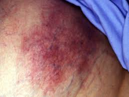 The evolution, morphology (purpura), distribution (acral) and infective prodrome of the patient's rash make viral ppgss the most likely diagnosis, despite this being rare. Retiform Purpura Dermnet Nz