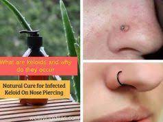 23 Anwendungen Von Vicks Vaporub Die Sie Uberraschen Werden Behandlung Von Kopf Bis Fuss Na Keloid Nose Piercing Care Nose Piercing