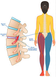 Image result for vyhřezlá ploténka