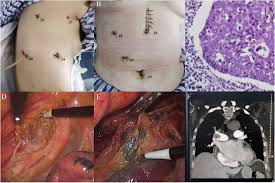 Or ivor lewis esophagectomy esophagectomy can be explained by omitting a third stage, the incision and the associated blood. Comparison Of Thoracolaparoscopic Esophagectomy With Cervical Anastomosis With Mckeown Esophagectomy For Middle Esophageal Cancer World Journal Of Surgical Oncology Full Text