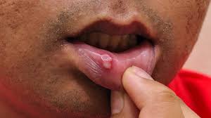 Image result for Mouth ulcers roof of mouth
