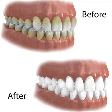 Zoom Teeth Whitening Patient Education Dedicated