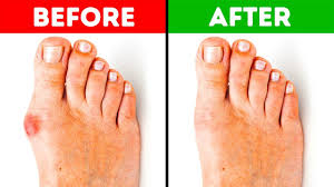Bunions are actually salt deposits. 5 Effective Ways To Get Rid Of Bunions Youtube