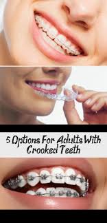 Options For Adults With Crooked Teeth It S Never Too Late To Fix Your Crooked Teeth And Get Back To Smiling Bigsmilelife T Crooked Teeth Teeth Teeth Health