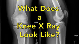 Image result for Knee XRay