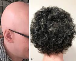 How is the treatment done ? Remission Of Alopecia Universalis In A Patient With Atopic Dermatitis Treated With Dupilumab Jaad Case Reports