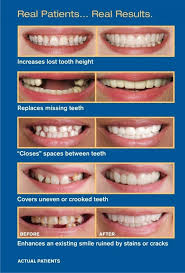 Maybe you would like to learn more about one of these? As Gigi Palsu Instan Snap On Perfect Smile Dengan Box Lazada Indonesia