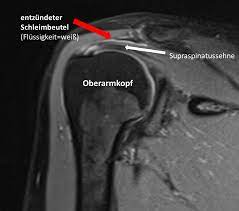 Impingement Syndrom Schulter