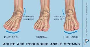 People might interchange the terms ankle sprain and ankle strain, but these terms are entirely different. Difference Between Acute And Recurring Ankle Sprains Mass4d Foot Orthotics