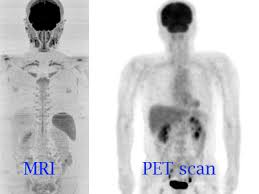 Effectiveness of ct scan for pancreatic cancer detection. News Page 6 Of 30 Omega Pds