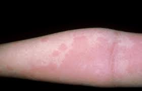 Photos And Symptoms Of Common Food Allergy Symptoms